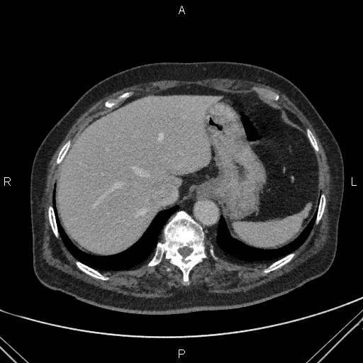 File:Acute renal artery occlusion (Radiopaedia 86586-102682 Axial C+ portal venous phase 8).jpg