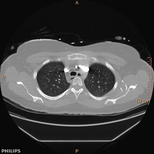 File:Acute reversible pulmonary hypertension and right heart failure from cocaine toxicity (Radiopaedia 49394-54517 Axial C+ CTPA 1).jpg