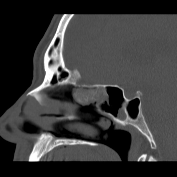 Acute sinusitis (Radiopaedia 23161-23215 Sagittal bone window 32).jpg