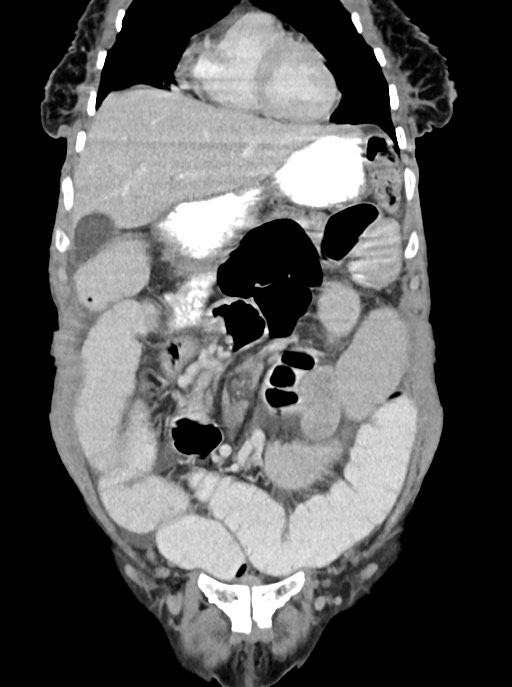 Acute small bowel (ileal) volvulus (Radiopaedia 71740-82139 Coronal C+ portal venous phase 35).jpg