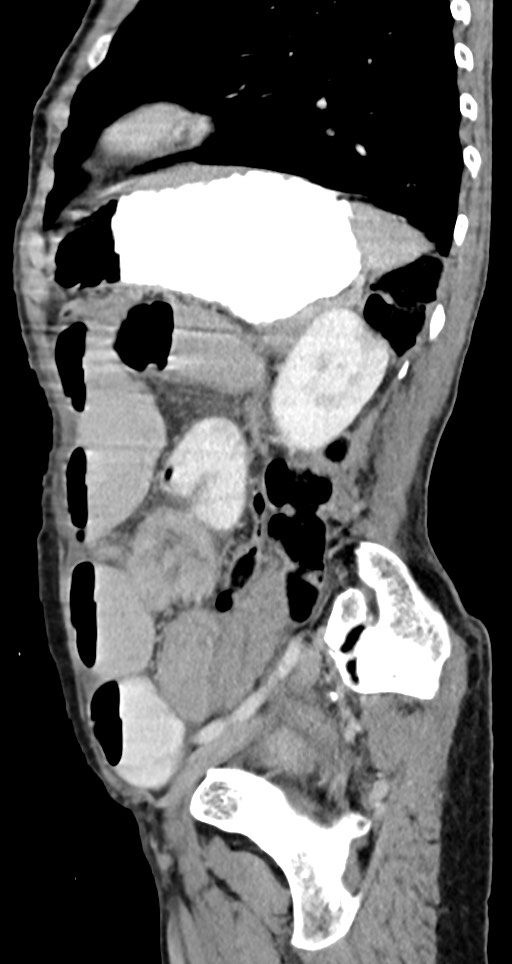 Acute small bowel (ileal) volvulus (Radiopaedia 71740-82139 Sagittal C+ portal venous phase 58).jpg