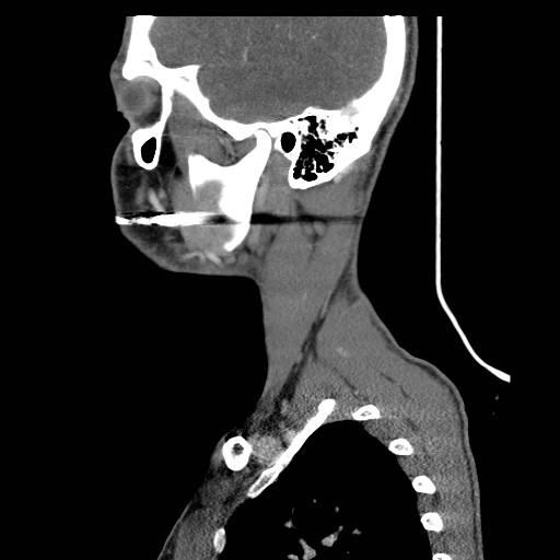 File:Acute submandibular sialadenitis secondary to ductal stone (Radiopaedia 27999-28267 Sagittal C+ delayed 38).jpg