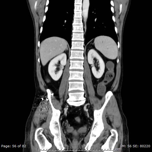 Acute superior mesenteric artery occlusion (Radiopaedia 43636-47060 Coronal C+ portal venous phase 41).jpg
