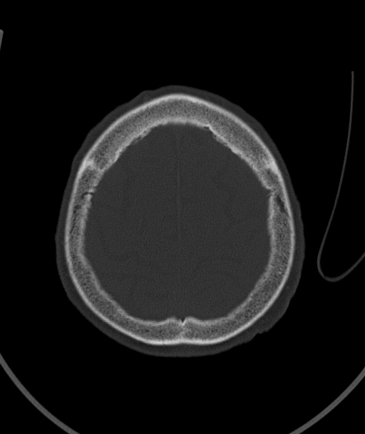 Acute traumatic subdural hematoma (Radiopaedia 82921-97257 Axial bone window 24).jpg