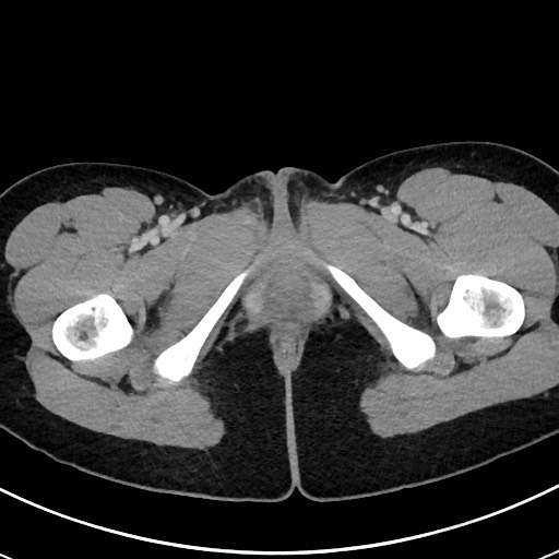 Acute uncomplicated appendicitis (Radiopaedia 61374-69304 Axial C+ portal venous phase 142).jpg