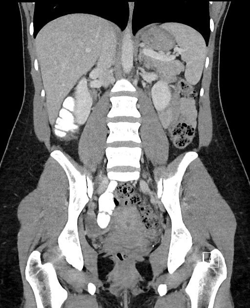 Acute uncomplicated appendicitis (Radiopaedia 61374-69304 Coronal C+ portal venous phase 61).jpg