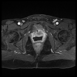 File:Adenocarcinoma arising in a urethral diverticulum (Radiopaedia 12400-12657 Axial T1 C+ fat sat 5).jpg