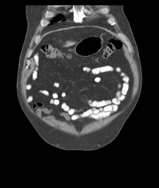 Adenocarcioma of rectum- T1 lesion (Radiopaedia 36921-38547 Coronal C+ portal venous phase 12).png