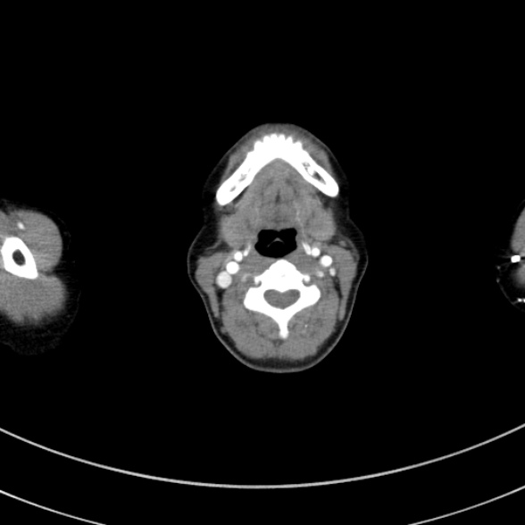 Adenocystic carcinoma of the trachea (Radiopaedia 47677-52525 Axial C+ arterial phase 15).jpg