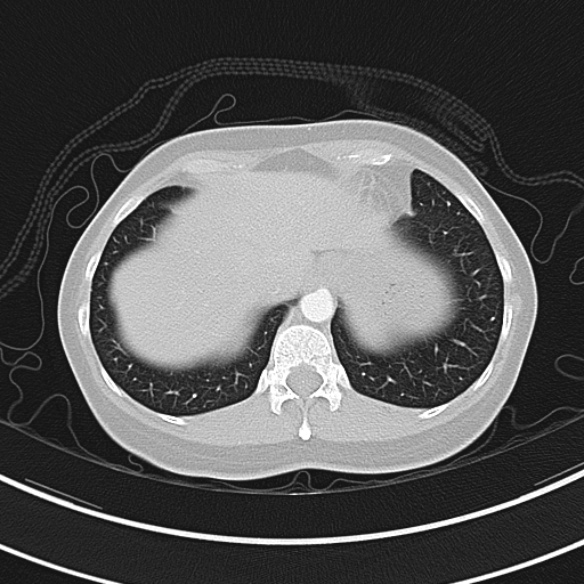 Adenocystic carcinoma of the trachea (Radiopaedia 47677-52525 Axial lung window 72).jpg