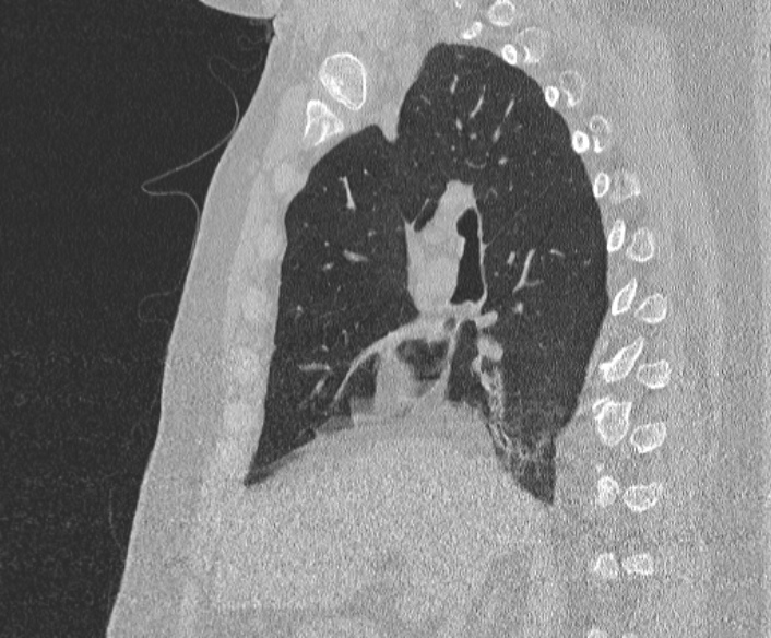 Adenoid cystic carcinoma of the trachea (Radiopaedia 49042-54137 Sagittal lung window 195).jpg