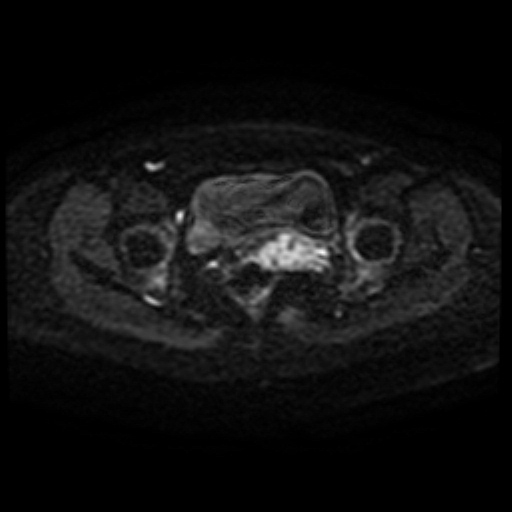 Adenoma malignum of cervix (Radiopaedia 66441-75705 Axial DWI 66).jpg