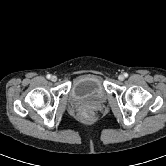 Adhesional small bowel obstruction (Radiopaedia 48397-53305 Axial C+ portal venous phase 92).jpg