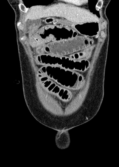 File:Adhesional small bowel obstruction (Radiopaedia 48397-53305 Coronal C+ portal venous phase 61).jpg