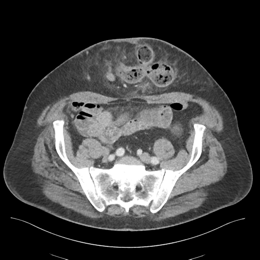 Adhesions within abdominal wall hernia (Radiopaedia 58283-65394 Axial C+ portal venous phase 63).png