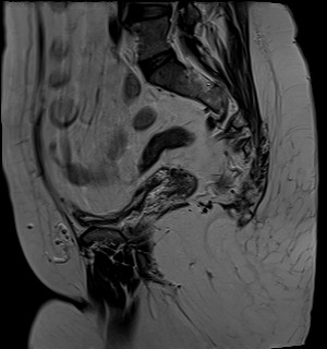 File:Adnexal multilocular cyst (O-RADS US 3- O-RADS MRI 3) (Radiopaedia 87426-103754 Sagittal T2 8).jpg