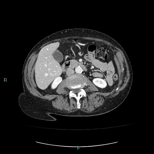 File:Adrenal collision tumor (ACT) (Radiopaedia 48462-53379 Axial C+ portal venous phase 29).jpg