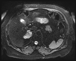 Adrenal cortical carcinoma (Radiopaedia 64017-72770 Axial DWI 11).jpg