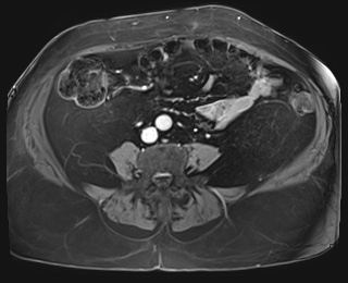 Adrenal cortical carcinoma (Radiopaedia 64017-72770 K 69).jpg