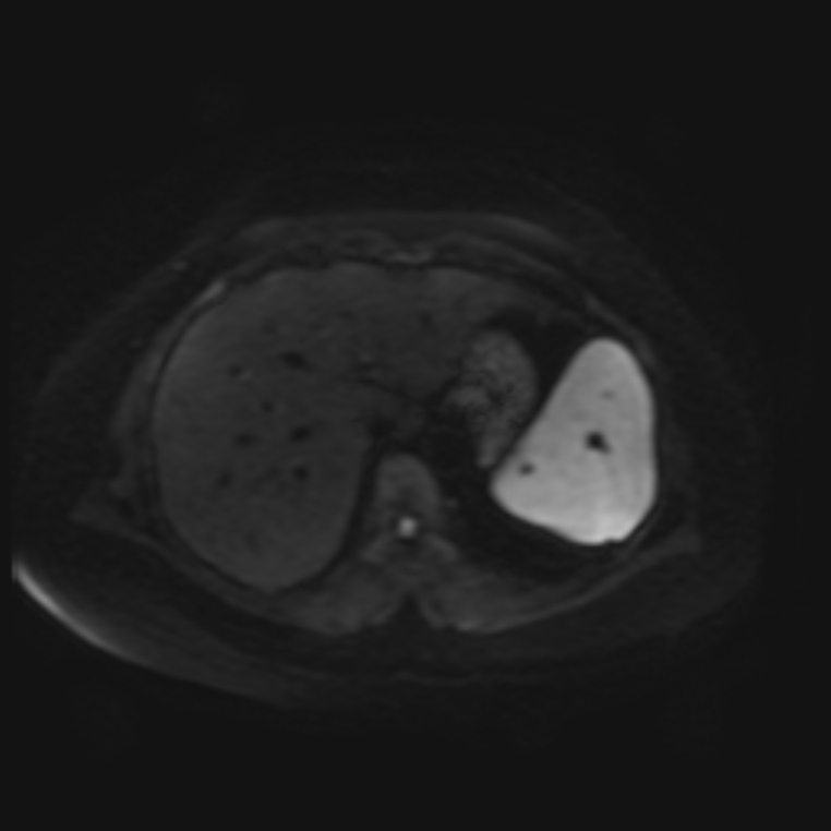Adrenal cortical carcinoma (Radiopaedia 70906-81116 Axial DWI 6).jpg