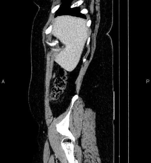 Adrenal cortical carcinoma (Radiopaedia 84882-100379 Sagittal C+ portal venous phase 11).jpg