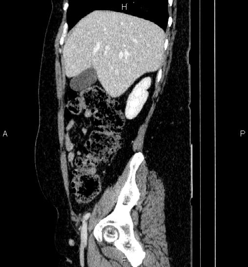 Adrenal cortical carcinoma (Radiopaedia 84882-100379 Sagittal C+ portal venous phase 22).jpg