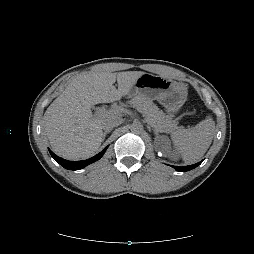 File:Adrenal cystic lymphangioma (Radiopaedia 83161-97534 Axial non-contrast 29).jpg