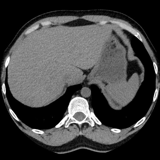 Adrenal gland trauma (Radiopaedia 81351-95079 Axial non-contrast 18).jpg