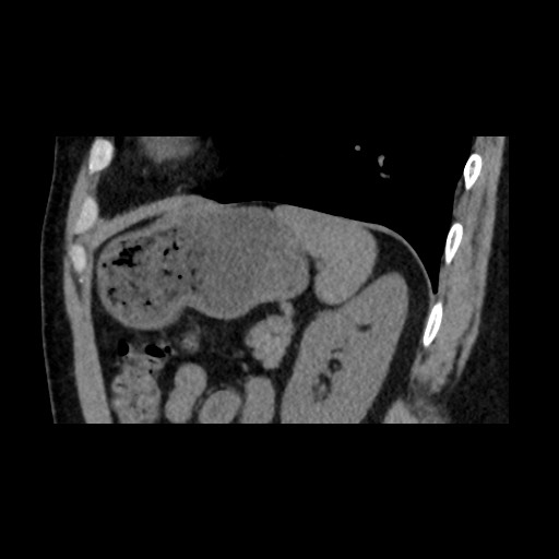 Adrenal gland trauma (Radiopaedia 81351-95079 Sagittal non-contrast 76).jpg