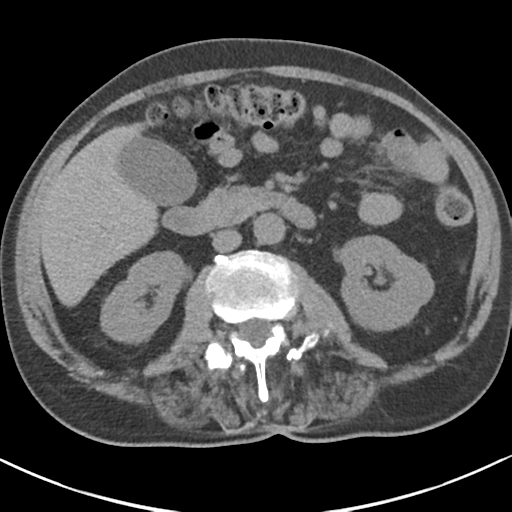 File:Adrenal hematoma (Radiopaedia 44334-47967 Axial non-contrast 45).png