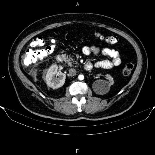 Adrenal hemorrhage (Radiopaedia 62622-70916 Axial C+ arterial phase 165).jpg