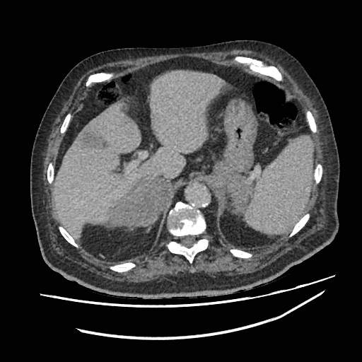 Adrenal lymphoma (Radiopaedia 84145-99415 Axial C+ portal venous phase 18).jpg
