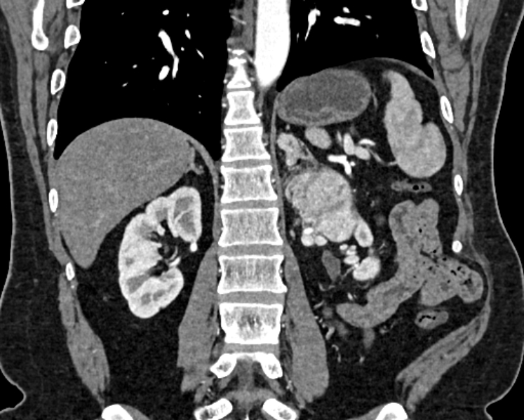 File:Adrenal metastases (Radiopaedia 73082-83791 Coronal C+ arterial phase 48).jpg