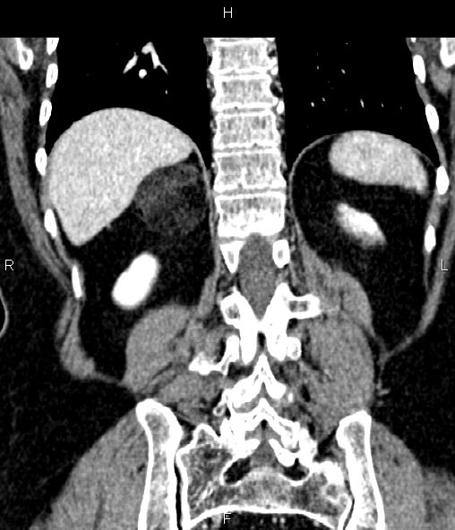 Adrenal myelolipoma (Radiopaedia 82742-96986 Coronal renal cortical phase 58).jpg