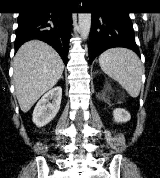 Adrenal myelolipoma (Radiopaedia 84319-99617 Coronal renal cortical phase 56).jpg