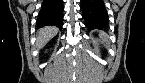 Adrenal myelolipoma (Radiopaedia 84321-99619 Coronal non-contrast 67).jpg
