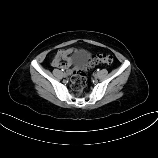 Adrenocortical carcinoma (Radiopaedia 87281-103569 Axial C+ arterial phase 69).jpg