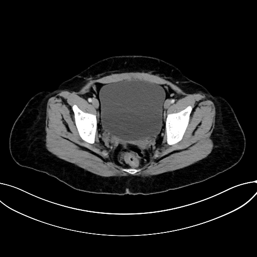File:Adrenocortical carcinoma (Radiopaedia 87281-103569 Axial C+ portal venous phase 78).jpg