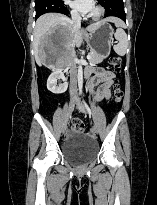 Adrenocortical carcinoma (Radiopaedia 87281-103569 Coronal C+ portal venous phase 47).jpg
