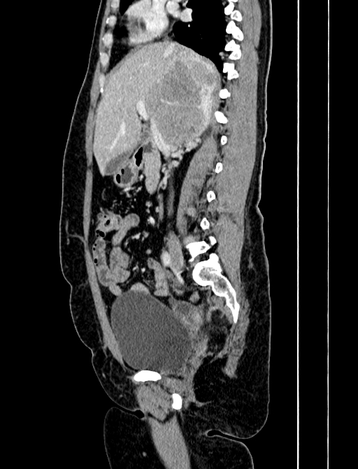 Adrenocortical carcinoma (Radiopaedia 87281-103569 Sagittal C+ portal venous phase 118).jpg