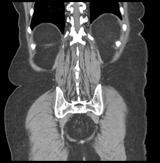 Adult ileal intussusception with secondary obstruction (Radiopaedia 30395-31051 Coronal C+ portal venous phase 52).jpg