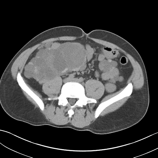 File:Adult polycystic kidney disease (Radiopaedia 47866-52626 Axial non-contrast 52).png