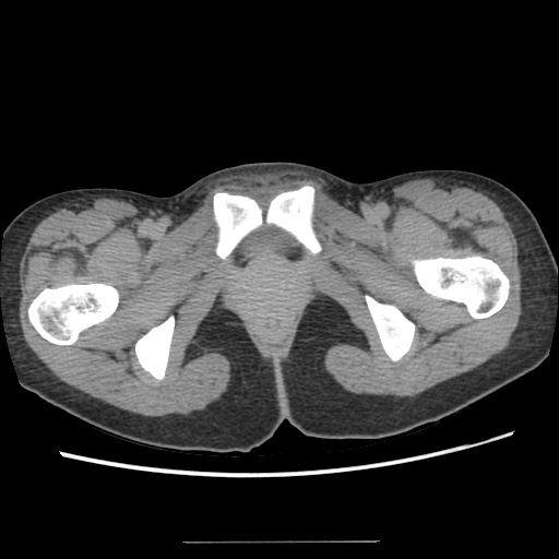 File:Adult polycystic kidney disease (Radiopaedia 48845-53876 Axial renal excretory phase 99).jpg