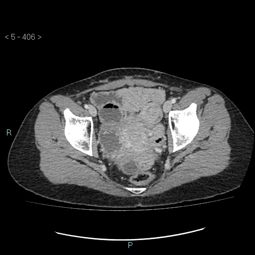 Adult transient intestinal intussusception (Radiopaedia 34853-36310 Axial C+ portal venous phase 106).jpg
