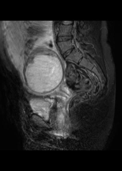 File:Aggressive angiomyxoma of the pelvis and perineum (Radiopaedia 59162-66479 Sagittal T2 fat sat 14).jpg