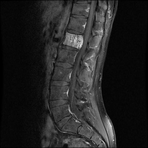 File:Aggressive vertebral hemangioma with pathological fracture (Radiopaedia 69528-79411 F 6).jpg