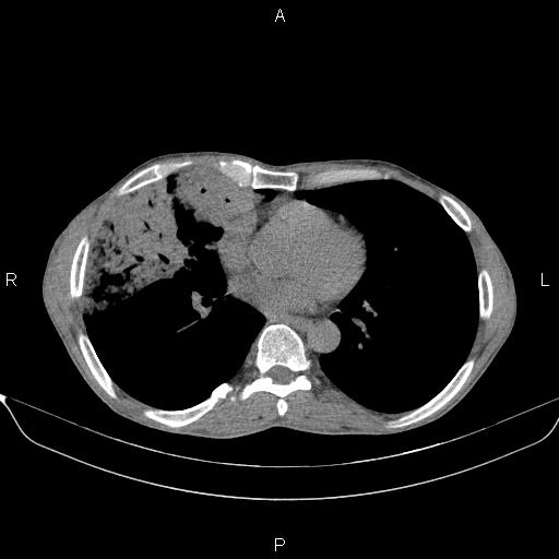 Air bronchogram in pneumonia (Radiopaedia 85719-101512 Axial non-contrast 40).jpg