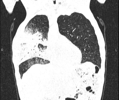Air bronchogram in pneumonia (Radiopaedia 85719-101512 Coronal lung window 18).jpg