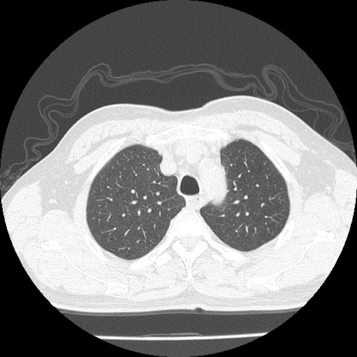 Airway foreign body in adult (Radiopaedia 85907-101779 Axial lung window 24).jpg