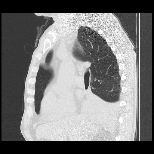 Allergic bronchopulmonary aspergillosis (ABPA) (Radiopaedia 60594-68313 Sagittal lung window 35).jpg